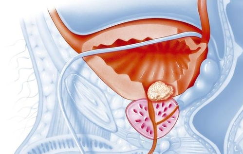 前列腺增生可以用什么藥 匯總4類西藥和9類中藥,建議收藏
