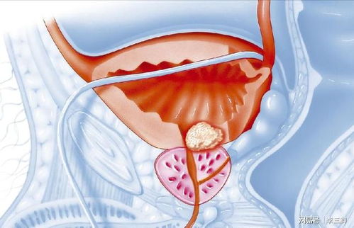 前列腺增生 病因、癥狀與應對策略